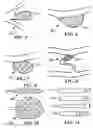 Fig. 05 - Stent with expandable foam