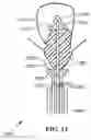 Fig. 06 - Stent with expandable foam