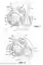 Fig. 06 - Mitral valve device using conditioned shape memory alloy