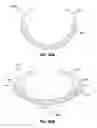 Fig. 22 - Adjustable annuloplasty ring activation system