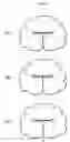 Fig. 03 - Selectively expandable composite structures for spinal arthroplasty
