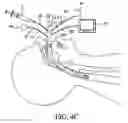 Fig. 06 - Visualization esophageal-tracheal airway apparatus and methods