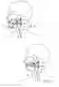 Fig. 08 - Devices, systems and methods using magnetic force systems affecting the tongue or hyoid muscles in the upper airway