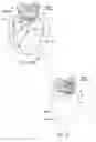 Fig. 30 - Devices, systems and methods using magnetic force systems affecting the tongue or hyoid muscles in the upper airway