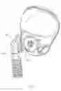 Fig. 03 - Breath controlled air inlet for blower