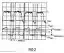 Fig. 03 - Domain expansion read-out for improved domain collapse