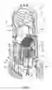 Fig. 02 - Instrument removal system