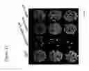 Fig. 14 - Nonsense suppression and genetic codon alteration by targeted modification