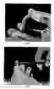 Fig. 02 - Pliable medical device and method of use