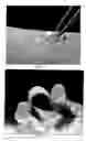 Fig. 03 - Pliable medical device and method of use