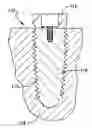 Fig. 01 - Polymeric dental implant assembly