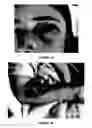 Fig. 14 - Immunoassay for venom detection including noninvasive sample collection
