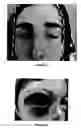 Fig. 16 - Immunoassay for venom detection including noninvasive sample collection