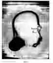 Fig. 02 - Coil ball
