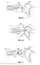 Fig. 07 - Apparatus for connection of implantable devices to the auditory system