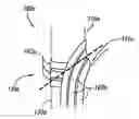 Fig. 01 - Methods and implantable apparatuses for treating an esophageal disorder such as gastroesophageal reflux disease