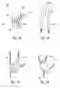 Fig. 03 - Methods and implantable apparatuses for treating an esophageal disorder such as gastroesophageal reflux disease