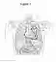 Fig. 11 - Detection of heart failure decompensation based on cumulative changes in sensor signals