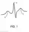 Fig. 02 - System and method for triggering a device based on an electrocardiogram signal