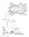 Fig. 11 - System and method for correcting clubfoot problems in children