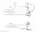 Fig. 14 - System and method for correcting clubfoot problems in children