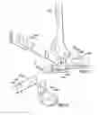 Fig. 18 - System and method for correcting clubfoot problems in children