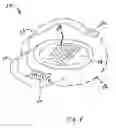 Fig. 02 - Devices and methods for promoting the formation of blood clots at dialysis access sites