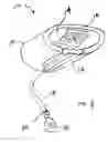 Fig. 04 - Devices and methods for promoting the formation of blood clots at dialysis access sites