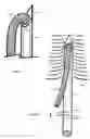 Fig. 02 - U-shaped disc shunt and delivery device