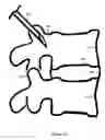 Fig. 08 - U-shaped disc shunt and delivery device