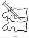 Fig. 10 - U-shaped disc shunt and delivery device