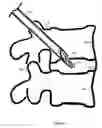 Fig. 11 - U-shaped disc shunt and delivery device