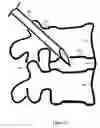 Fig. 12 - U-shaped disc shunt and delivery device