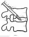 Fig. 13 - U-shaped disc shunt and delivery device