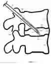 Fig. 14 - U-shaped disc shunt and delivery device