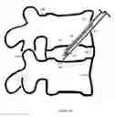 Fig. 16 - U-shaped disc shunt and delivery device