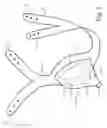 Fig. 02 - Urinary incontinence device