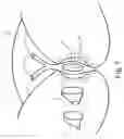Fig. 06 - Urinary incontinence device