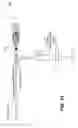 Fig. 16 - Method and apparatus for controlled vessel occlusion