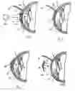 Fig. 03 - METHOD AND SYSTEM FOR ALTERING THE REFRACTIVE PROPERTIES OF THE EYE