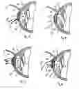 Fig. 05 - METHOD AND SYSTEM FOR ALTERING THE REFRACTIVE PROPERTIES OF THE EYE