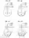 Fig. 03 - Ablation device with compression balloon
