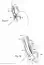 Fig. 09 - Surgical instruments and techniques for treating gastro-esophageal reflux disease