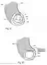 Fig. 10 - Surgical instruments and techniques for treating gastro-esophageal reflux disease
