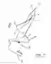 Fig. 04 - Threaded suture anchor with starting pitch