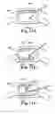 Fig. 17 - Device, system and method for delivering a curable material into bone
