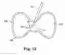 Fig. 18 - Device, system and method for delivering a curable material into bone