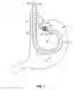 Fig. 02 - Helical tissue manipulation instruments and methods of use