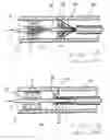 Fig. 02 - Interventional catheter for retrograde use having embolic protection capability and methods of use