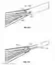 Fig. 19 - Cervical clamp apparatus and method of exerting a compressive force to a cervix